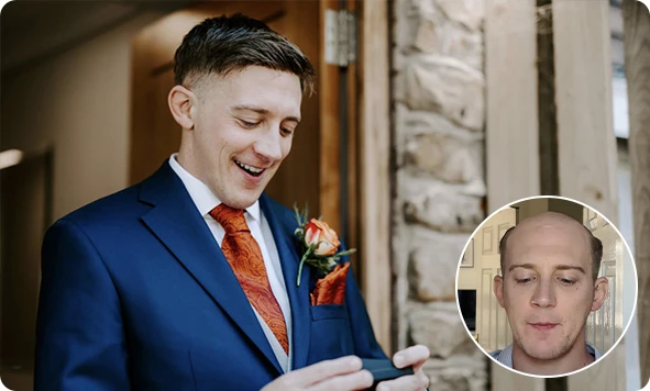 What Is a Hair System?